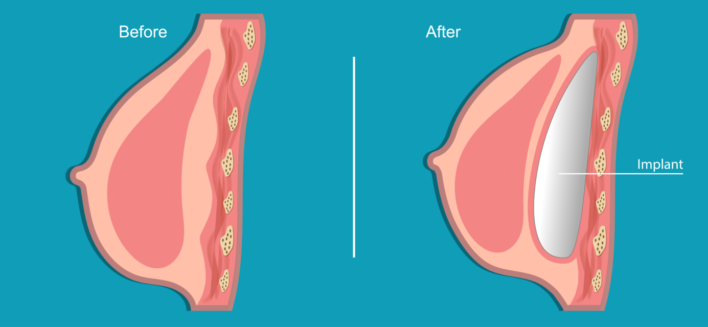 Key Incision Breast Augmentation Mini Breast Augmentation (Mammoplasty) - Cranford House Plastic Surgery